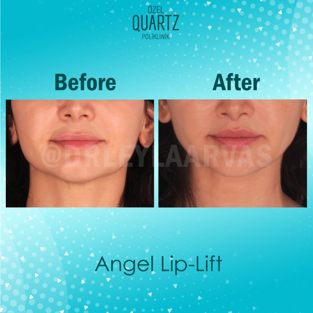 lip lift