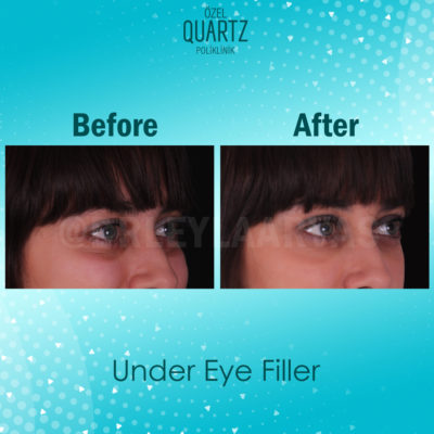 Under Eye Light Filler