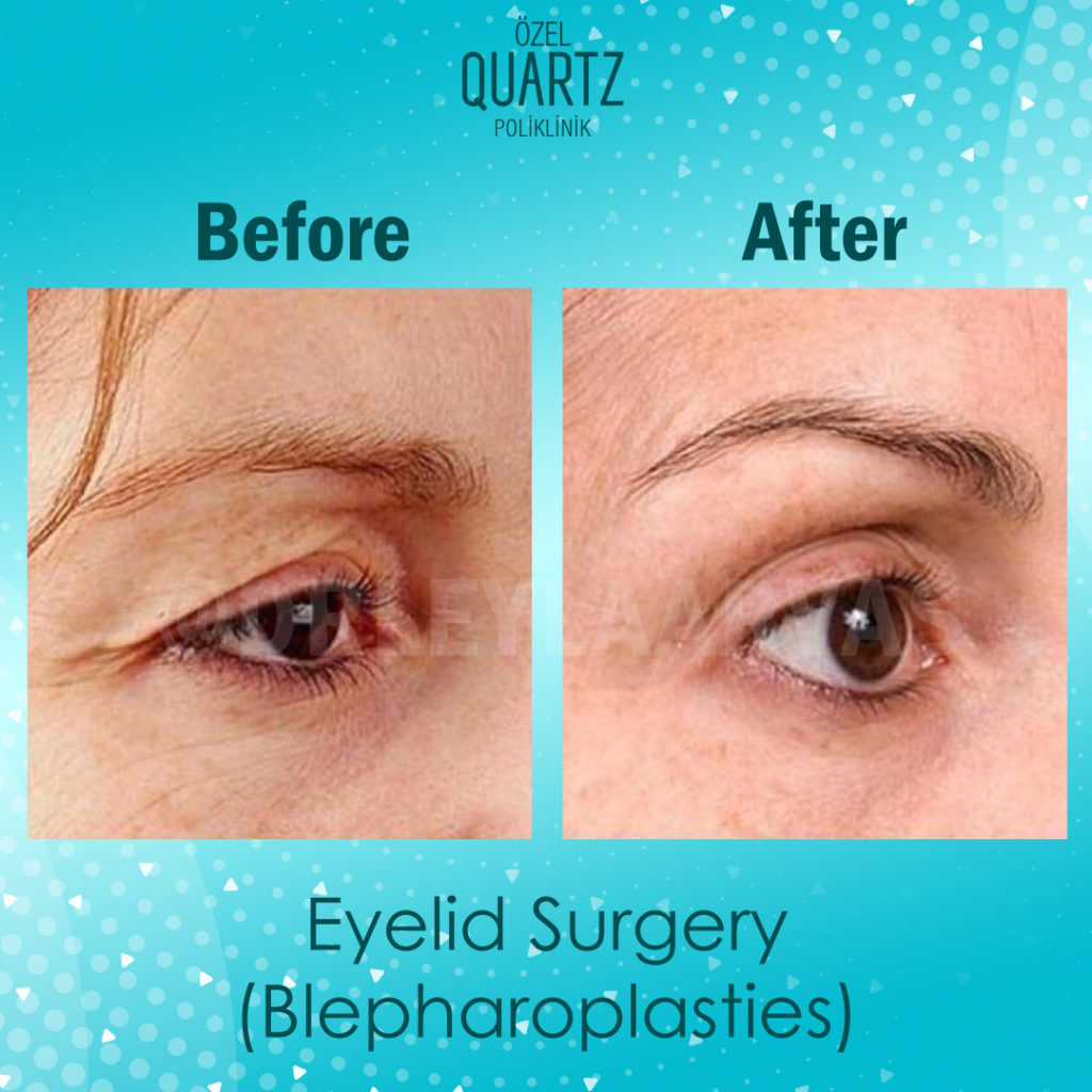 Eyelid Surgery