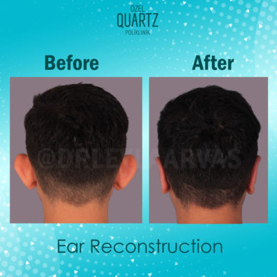 ear reconstruction