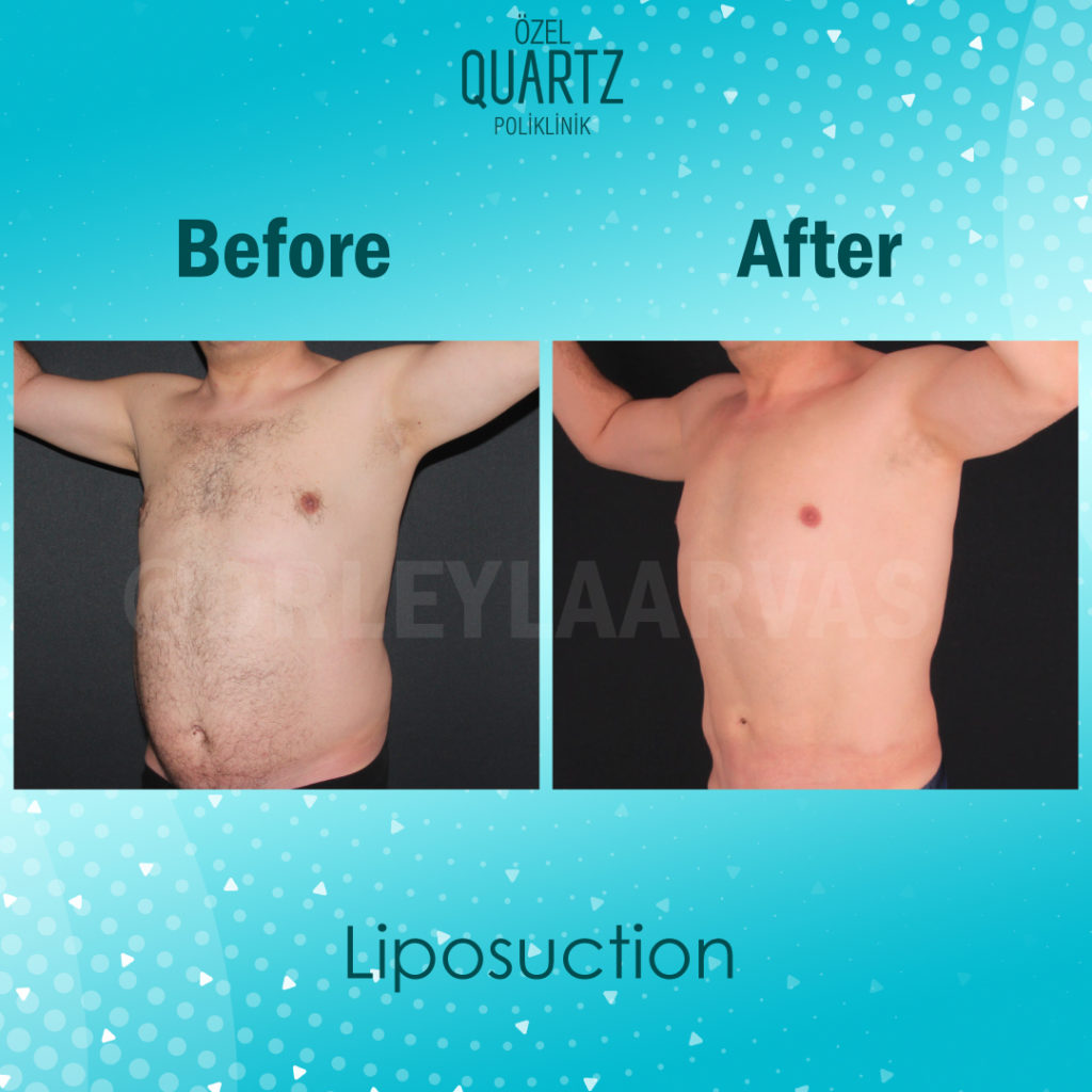 liposuction