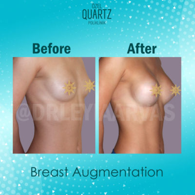 breast augmentation