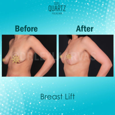 breast lift