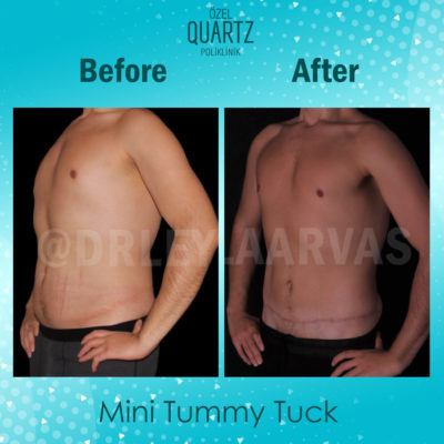 mini tummy tuck