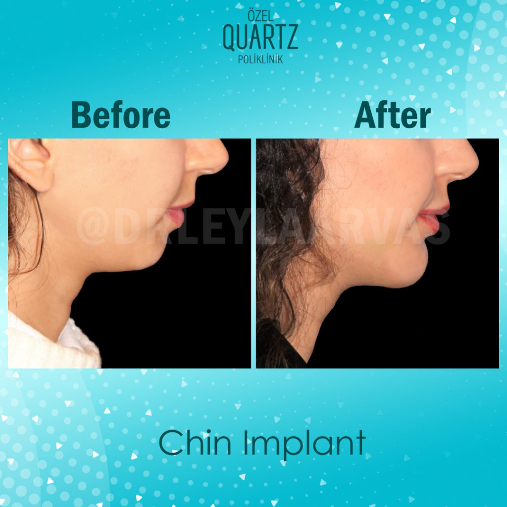 Chin Implant