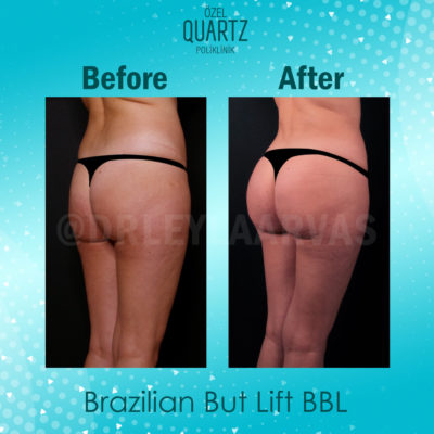 Brazilian butt lift