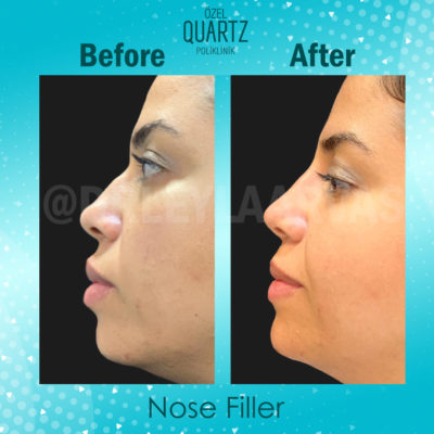 nose filler